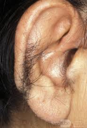 Unwanted hairs on the ears.